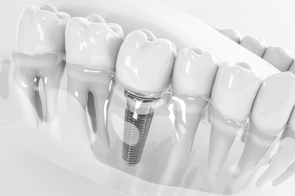 Vedere de sus a unui implant dentar fixat în osul maxilarului; 3D; Ilustrație 3D