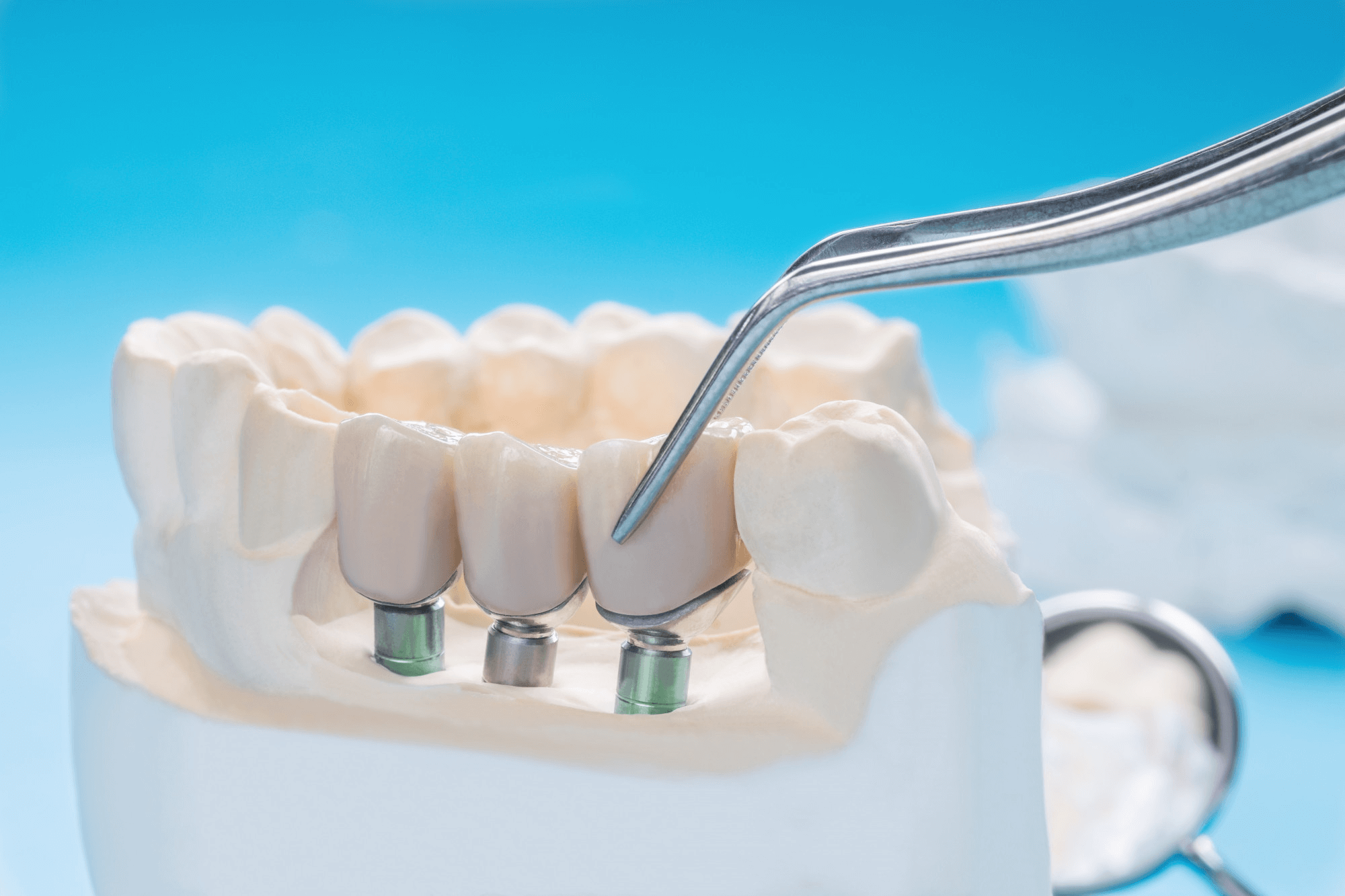 plan lateral gura implant dentar